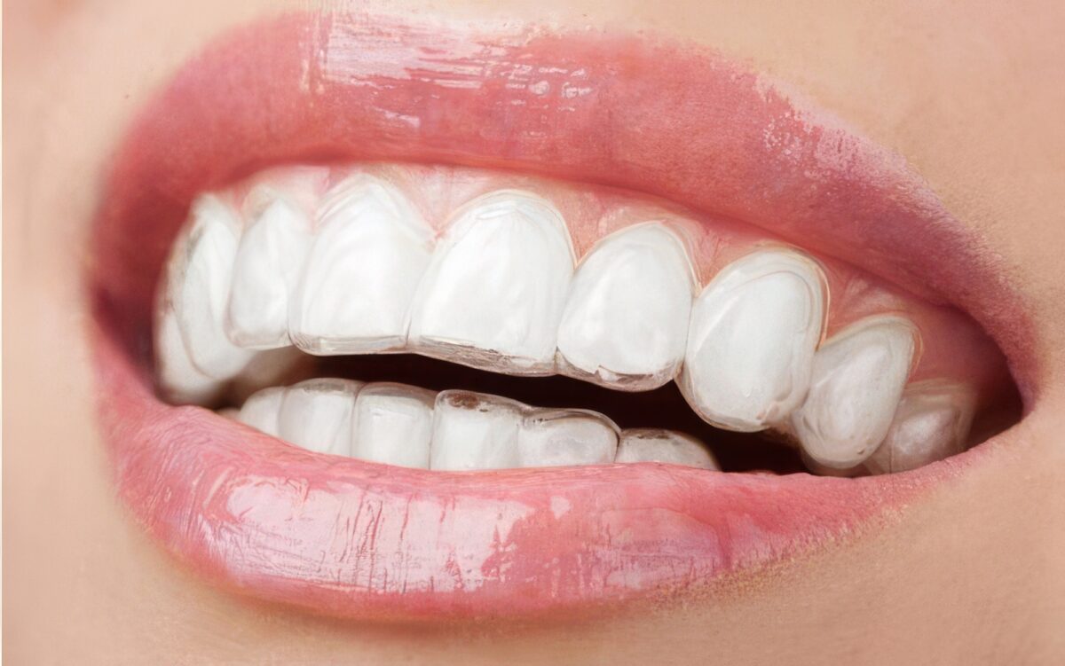 Invisalign-1200x751.jpg