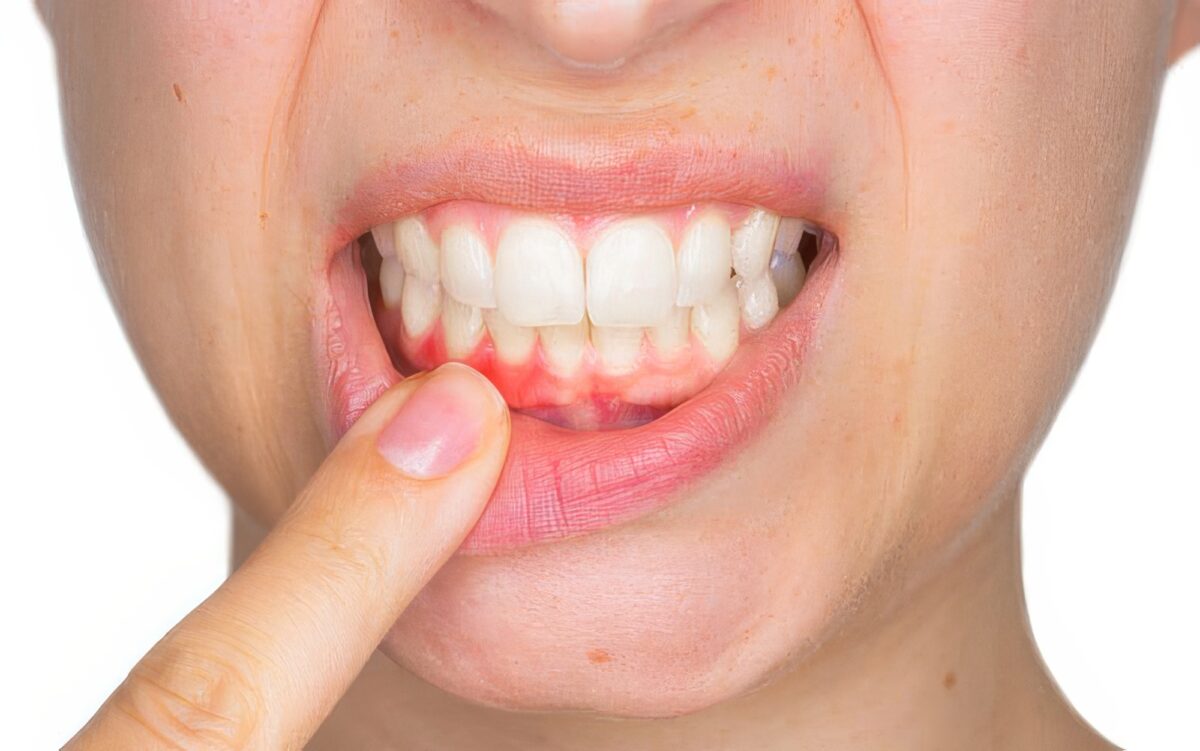 Periodontal-Gum-Treatment-1200x751.jpg