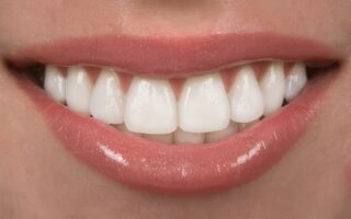 Close-up of a person smiling with porcelain veneers, showcasing the results of cosmetic dentistry.