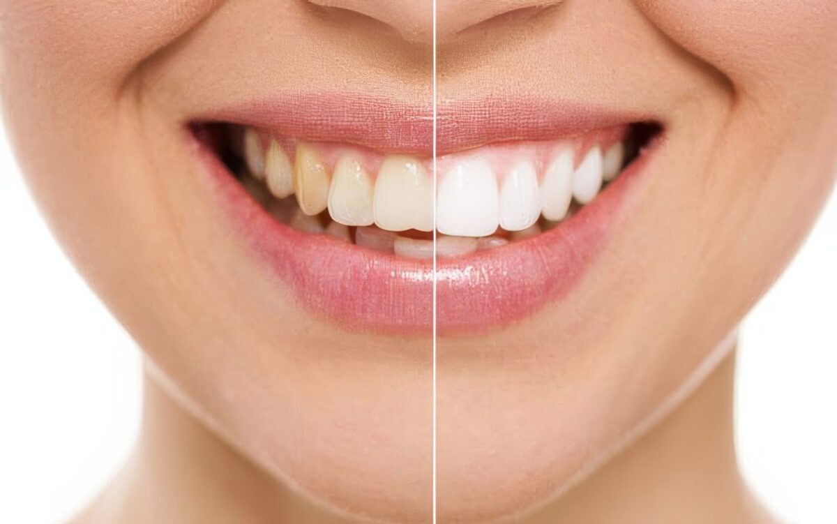 Teeth-Whitening-1200x751.jpg